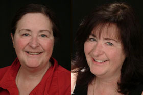 Vancouver Island Smile Makeover