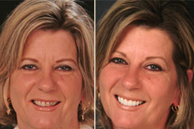 Vancouver Island Smile Makeover