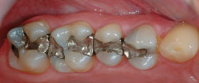 Vancouver Island Tooth Colored Composite Fillings