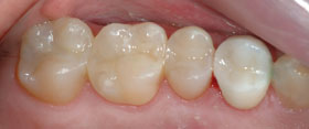 Vancouver Island Tooth Colored Composite Fillings